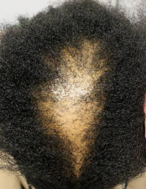 black woman androgenic alopecia_0